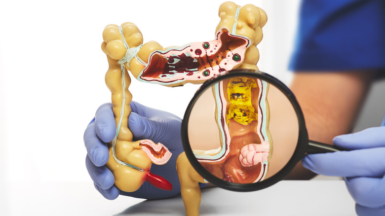 Colon cancer symptoms